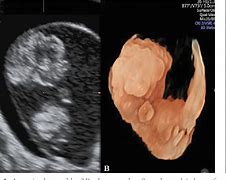 Image result for Exencephaly Fetal Ultrasound