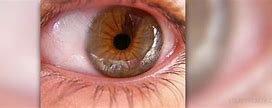 Image result for Bad Laser Eye Surgery