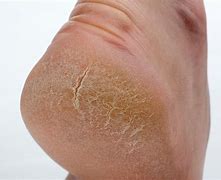 Image result for What Causes Dry Cracked Feet