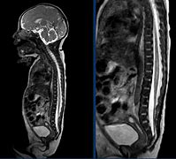 Image result for Baby Brain with Spinal Cord Images