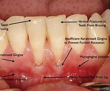 Image result for Gingival Papilloma