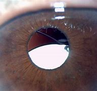 Image result for Displaced Cataract