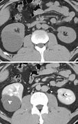 Image result for Renal Cyst MRI