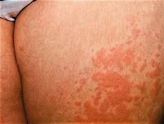 Image result for Skin Eruptions with Blisters