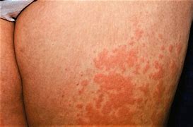 Image result for Cutaneous Eruptions Painful