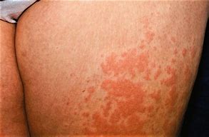 Image result for What Causes Skin Eruptions