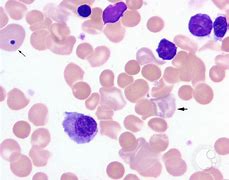 Image result for Erythroblastosis