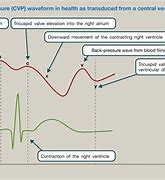 Image result for Central Venous Pressure Readings