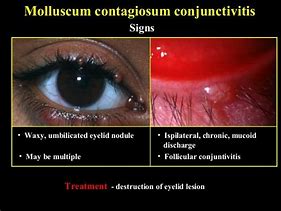 Image result for Molluscum Contagiosum Conjunctivitis Treatment