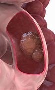 Image result for Small Bowel Tumors
