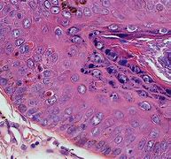 Image result for Dog Skin Papilloma Wart