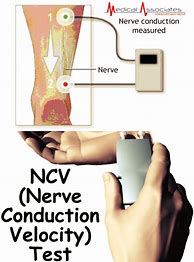 Image result for EMG/Nerve Conduction Test