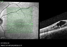 Image result for Macular Retinoschisis Oct