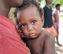 Image result for Microcephaly Solomon Islands