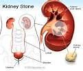 Image result for What Does a Kidney Stone Look Like