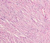 Image result for Fibrous Meningioma