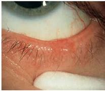 Image result for Eyelid Margin Papilloma