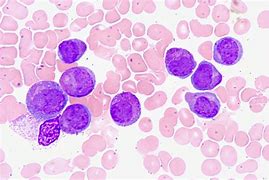 Image result for Acute Myelocytic Leukemia