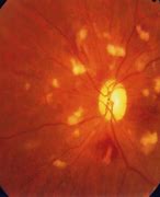 Image result for Solar Maculopathy Oct