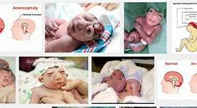 Image result for Anencephaly Treatments