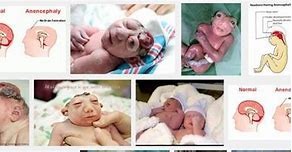 Image result for Anencephaly Treatments