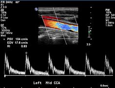 Image result for Carotid Artery Ultrasound Screening