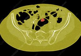 Image result for Colon Polyps Symptoms