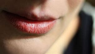 Image result for Chapped Inside Lips