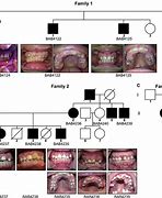 Image result for Hereditary Gingival Fibromatosis