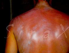 Image result for Sun Burn Rash/Bumps