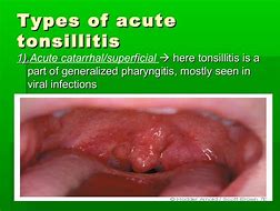 Image result for EBV Tonsillitis