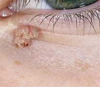 Image result for Wart On Inside of Eyelid