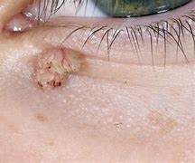 Image result for Wart Inside Eyelid
