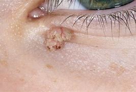 Image result for Wart On Upper Eyelid