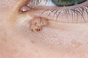 Image result for Eyelid Wart