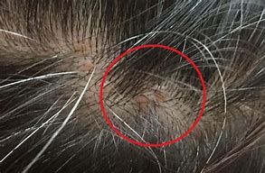 Image result for Hard Pebbles in the Scalp