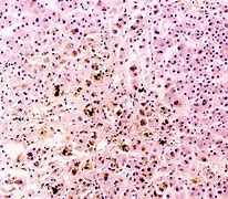 Image result for hemoc5omatosis