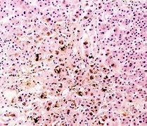 Image result for hemocrpmatosis