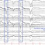 Image result for Eye Artifacts in EEG