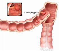 Image result for Sessile Colon Polyps and Cancer