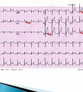 Image result for MI EKG