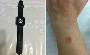 Image result for Apple Watch Burns