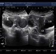 Image result for Bilateral Ovarian Cysts