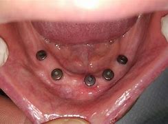 Image result for OPG Edentulous
