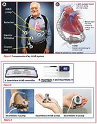 Image result for Ventricular Assist Device