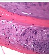 Image result for Squamous Cell Papilloma in Mouth