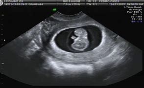 Image result for Ultrasound at 9 Weeks