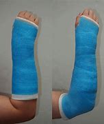 Image result for Short Arm Cast Drawing