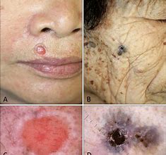 Image result for Ulcerated Squamous Cell Carcinoma