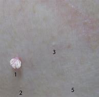 Image result for Warts On Skin Pictures